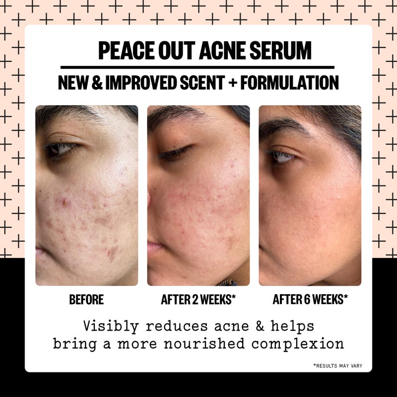 PEACE OUT Skincare Acne Serum. Daily Multi-Benefit Face Serum with 2% Salicylic Acid to Target Pimples, Zits, Blemishes and Breakouts, For Clearer-Looking Skin 1 fl oz - Image 4
