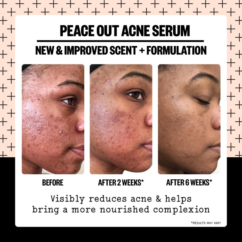PEACE OUT Skincare Acne Serum. Daily Multi-Benefit Face Serum with 2% Salicylic Acid to Target Pimples, Zits, Blemishes and Breakouts, For Clearer-Looking Skin 1 fl oz - Image 3