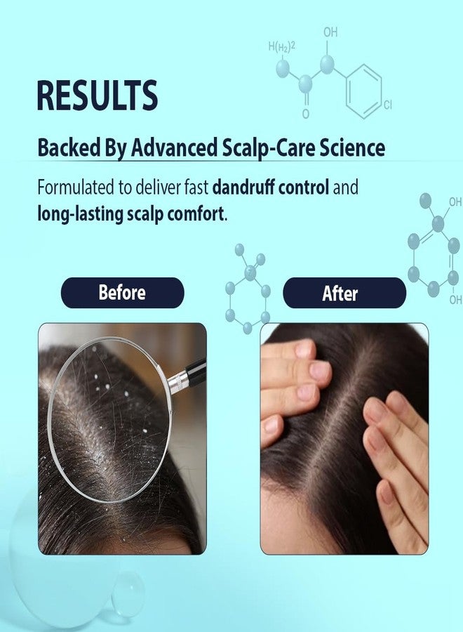 Dermistry Anti-Dandruff Contol Shampoo Climbazole Piroctone ZPTO Reduces Dryness Flakes Itching Irritation Exfoliates Both Dry & Oily Itchy Scalp Suits Dry Frizzy Curly All Hair Types Men Women 200ml - Image 5
