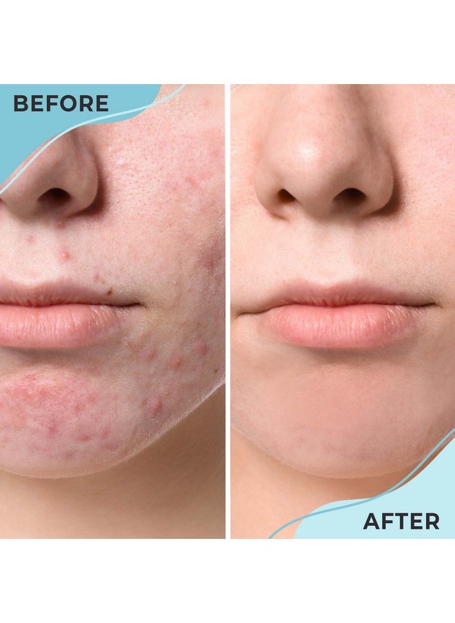 AYADARA - Cystic Acne Spot Treatment, Overnight Hormonal Cystic Acne Treatment For Face, Women, Men And Teens, Cystic Hormonal Acne Treatment For Body, Pimple Cream, Sulfur Acne Spot Treatment, 120 Uses - Image 1