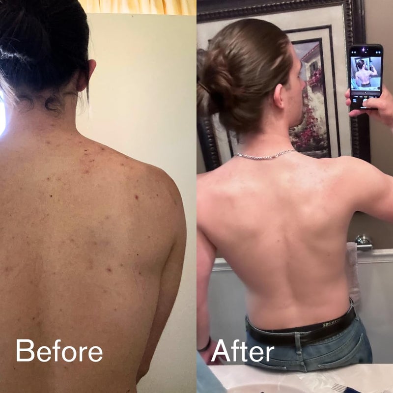 Shield غسول حب الشباب للجسم للرجال والأولاد بدون رائحة 85 أونصة - Image 4