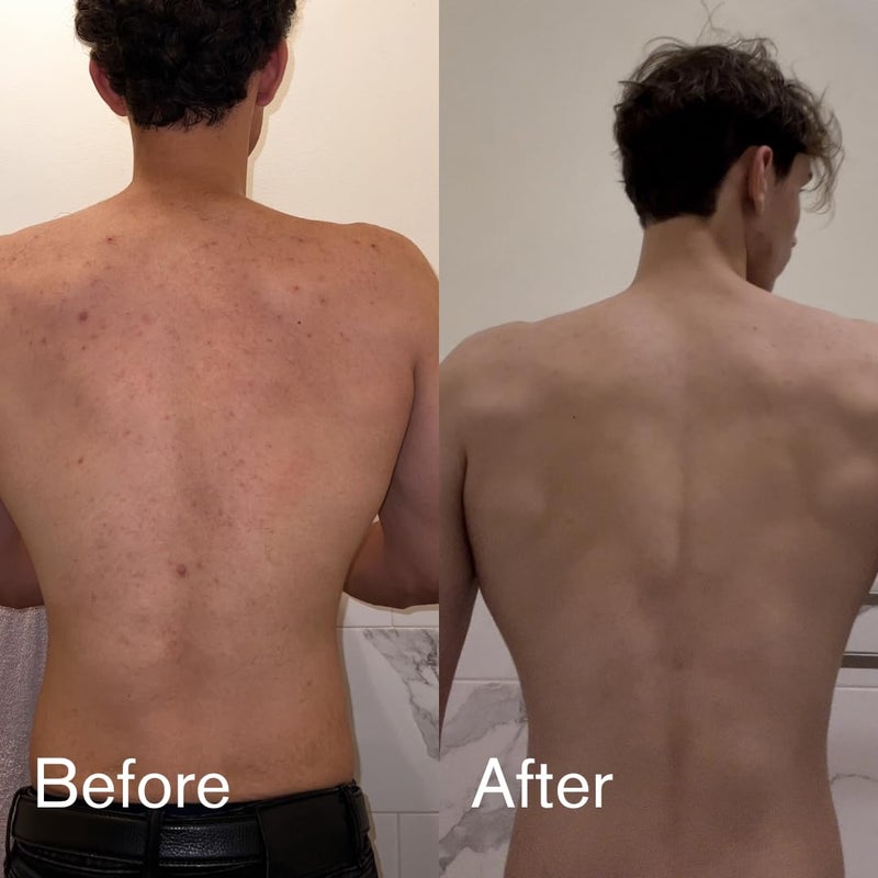 Shield غسول حب الشباب للجسم للرجال والأولاد بدون رائحة 85 أونصة - Image 5