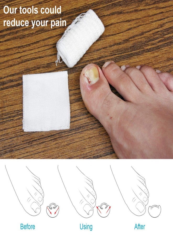 jeoga Professional Ingrown Toenail Fixer - Adjustable Stainless Steel Toe Nail Correction Tool with Screw Mechanism for Severe Ingrown Toenail Relief, Pain-Free Pedicure Kit for Men & Women - Image 2