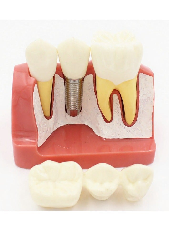 Dental IMPLANT Teaching Model