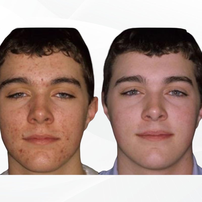 Acnetame Acne Pills 30 Day- Supplements for Acne Vitamin Treatment- Tablets to Clear Oily Skin for Women, Men, Teens, and Adults - Image 3