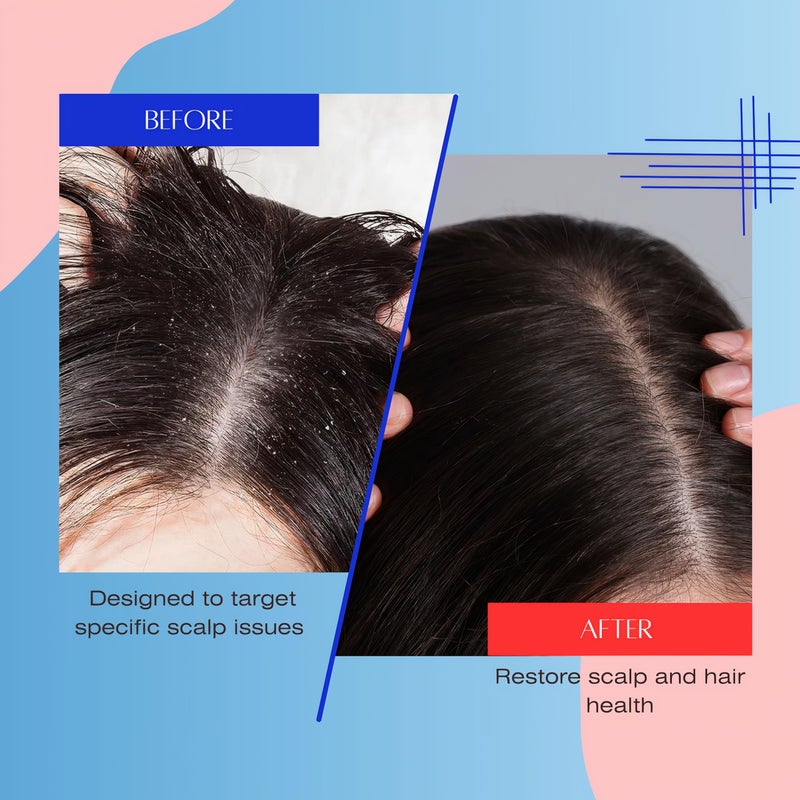 Mediceuticals شامبو ميديسوتيكالز سولف-إكس - للشعر وفروة الرأس الدهنية - شامبو حب الشباب لفروة الرأس للرجال والنساء والمراهقين 8.45 أونصة (250 مل) - Image 5