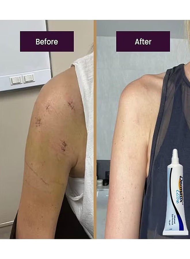 ديرماتيكس جل ندبة متقدم 15 جم لتحسين الندبات التجميلية ، وتجفيف سريع وتركيبة جل سيليكون فريدة من نوعها ، يستخدم لعلاج الجدرة والندبات الجراحية والضخامية ، ومناسب للبشرة الحساسة - Image 3
