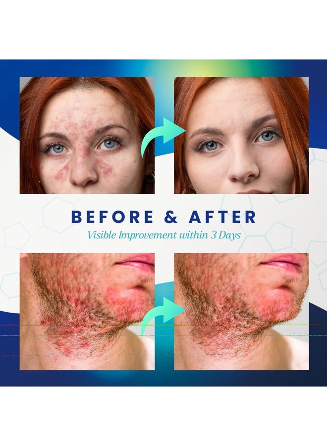 PureSkin كريم التهاب الجلد الدهني كيتوكونازول: علاج الصدفية والإكزيما - تخفيف إضافي للجلد المتقشر والمتهيج 3.4 أونصة - Image 4