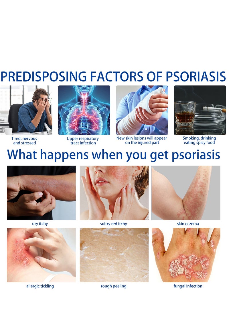 ساوث مون كريم مضاد للبكتيريا للصدفية والأكزيما كريم مضاد للفطريات ، يساعد على الأكزيما ، كريم مضاد للسعفة مضاد للحكة بمكونات عشبية ألطف وأكثر أمانا يعيد الحكة بسرعة للوجه والجسم 20 جرام - Image 3