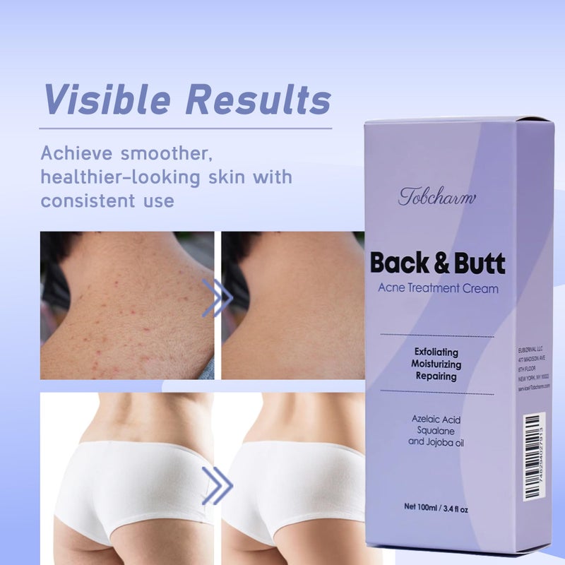 Tobcharm Butt Acne Clearing Treatment, Maximum Strength Body Cream for Back, Buttocks, Thigh & Chest Acne Removal, Skin Clearing Lotion for Men & Women, Foaming Cleanser for Bacne & Cystic Acne - Image 2