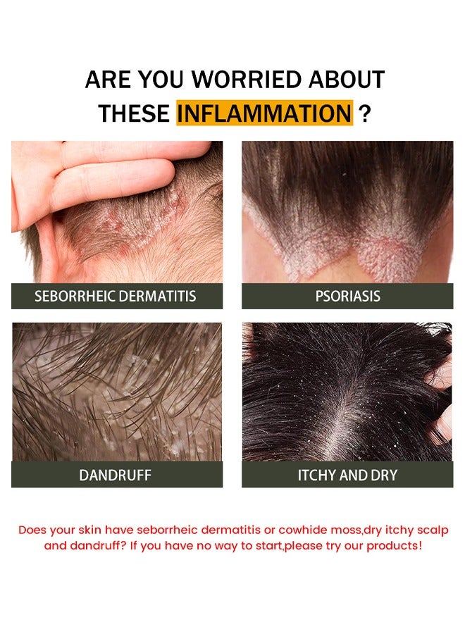 سوميفون كريم التهاب الجلد الدهني - كريم للعناية بفروة الرأس ، كريم لفروة الرأس المعرضة لالتهاب الجريبات ، التهاب الجلد ، قشرة الرأس ، العث ، حكة وفروة الرأس ، يعالج قشرة الرأس والتهاب الجلد الدهني - Image 4