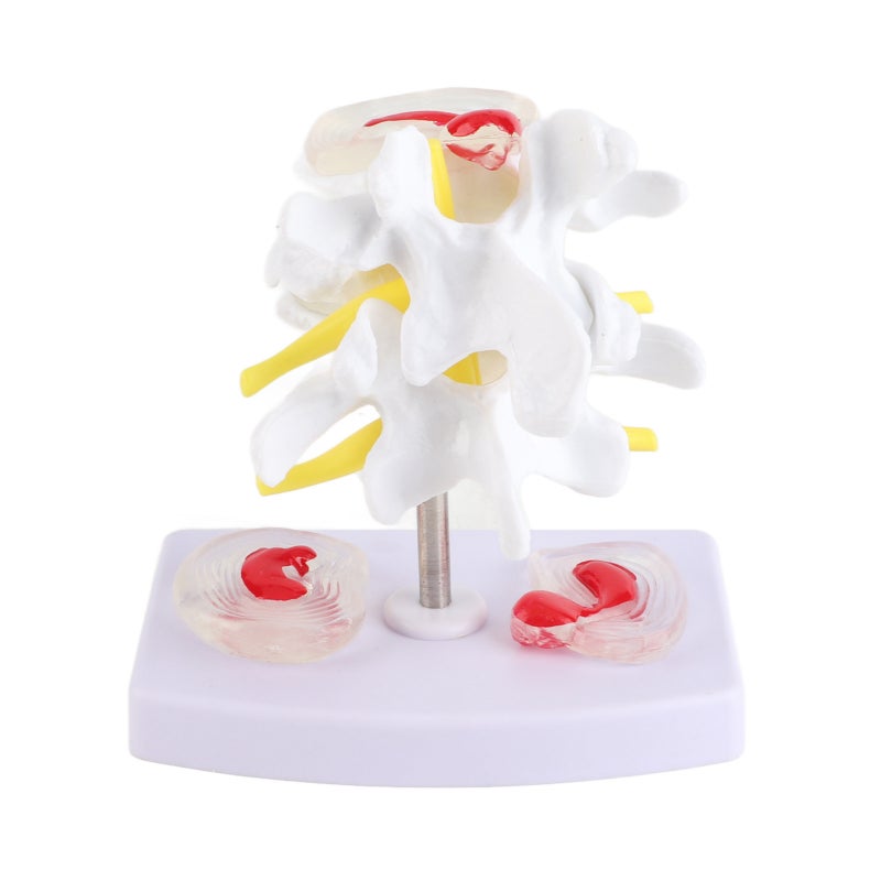 Human Spine Model: 1 Anatomical Lumbar Disc Herniation Model With 2 Diseased Intervertebral Discs Spinal Nerves - Base Mounted Vivid Detailed Structure For Medical Training Doctor Patient Communicatio - Image 3