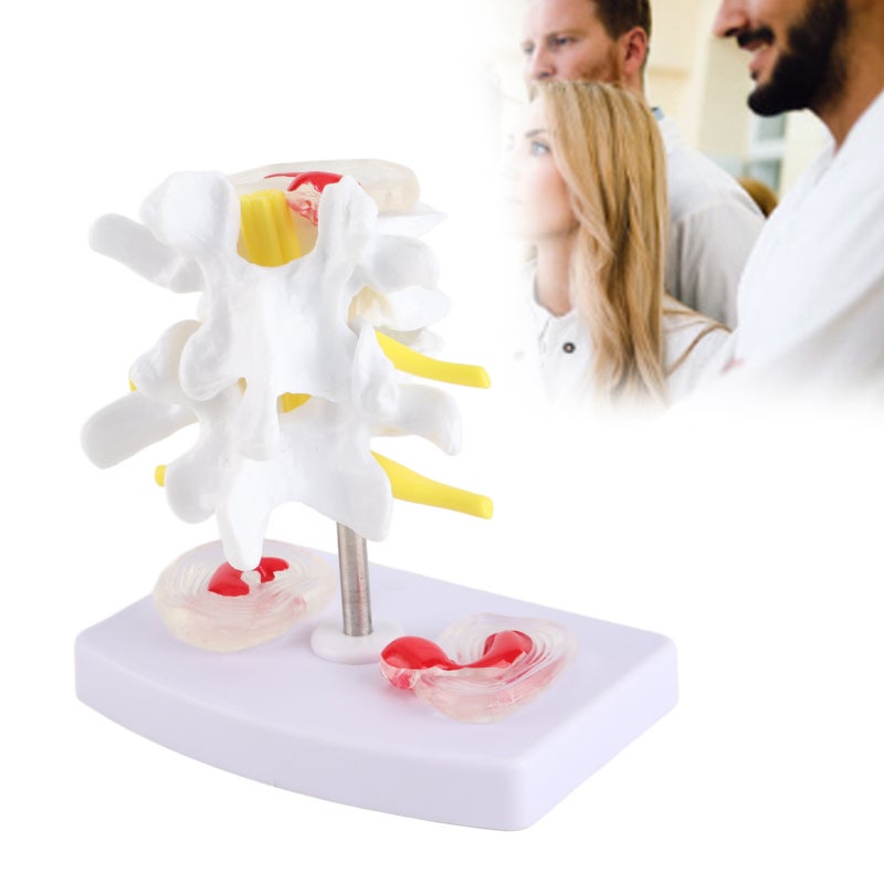 Human Spine Model: 1 Anatomical Lumbar Disc Herniation Model With 2 Diseased Intervertebral Discs Spinal Nerves - Base Mounted Vivid Detailed Structure For Medical Training Doctor Patient Communicatio - Image 2