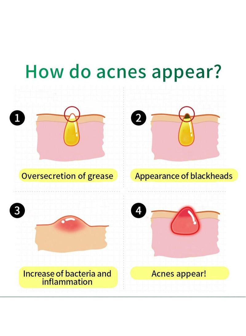 Breylee Acne treatment cream acne removal acne pimple repair cream 20g - Image 5