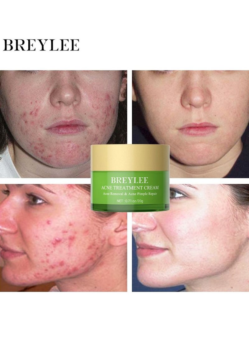 Breylee Acne treatment cream acne removal acne pimple repair cream 20g - Image 2