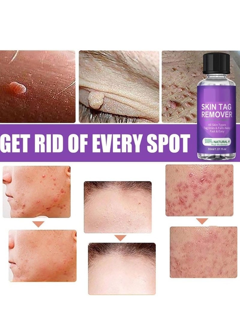 EELHOE Skin Tag Remover, Natural Wart and Mole Removal with Safe Ingredients â Effective Frozen Formula for Skin Renewal without Irritation, Easy to Use for Face and Body (30 ml) - Image 3