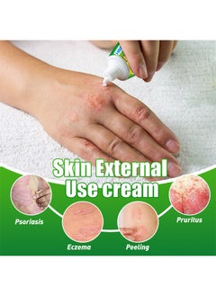 HBESTY Natural Chinese Herbal Eczema Ointment, Dermatitis And Eczema Pruritus Psoriasis Ointment, Psoriasis Creams, Psoriasis Treatment, Antibacterial Cream For Body Itching 20G  - Image 4