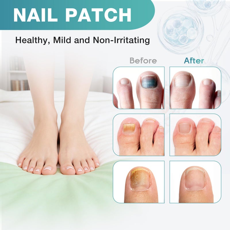 DR.RAPID Fungal Nail Patches, Toenail Fungus Treatment Extra Strength - 20 Fungal Nail Patches for Toe Nail Fungus Treatments, 8-Hour Nighttime Nail Fungus Patches for Nail Fungus Treatment - Image 5