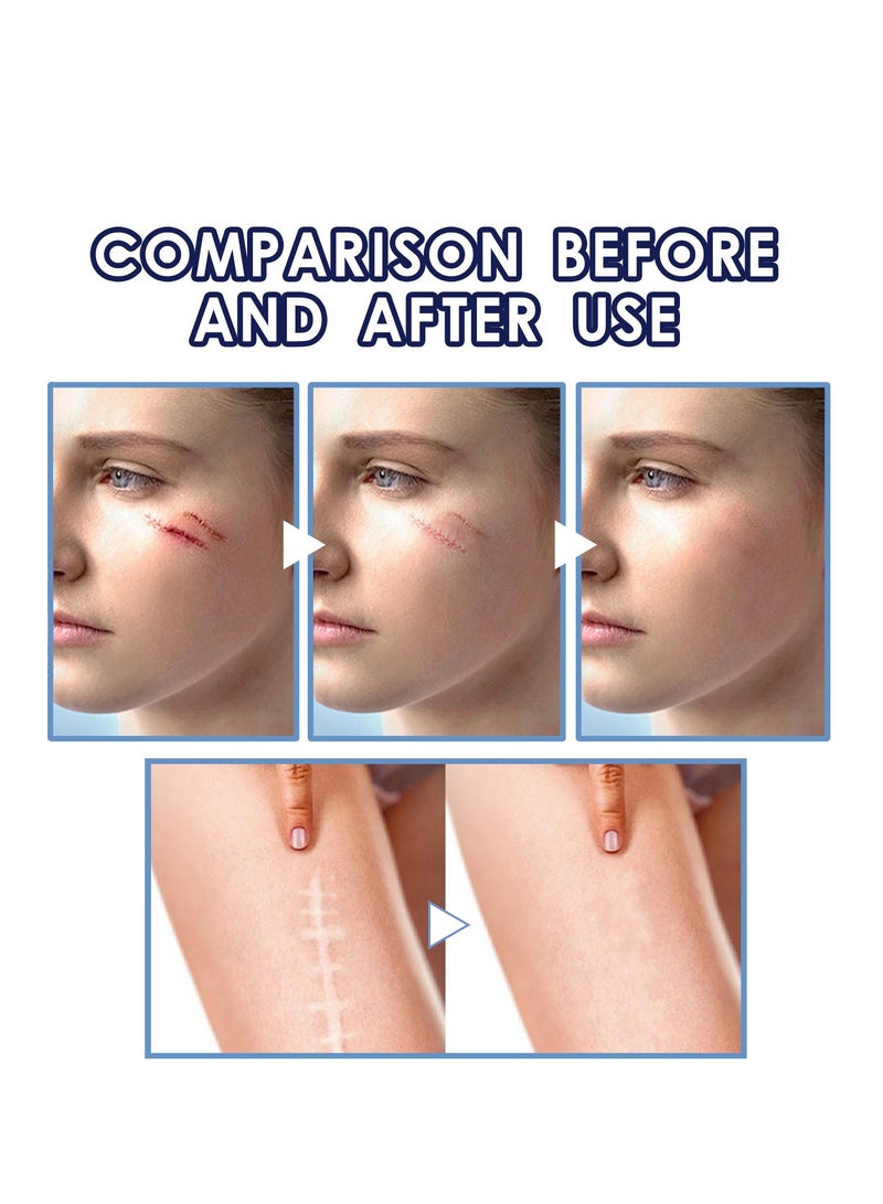 إيلهو كريم إزالة الندبات بمركب دايميثيكون 2% تأثير سريع لحرق الحمل الجديد والقديم وندبات العمليات لإصلاح الجلد التالف وتغذيته وتفتيحه 50 مل - Image 3