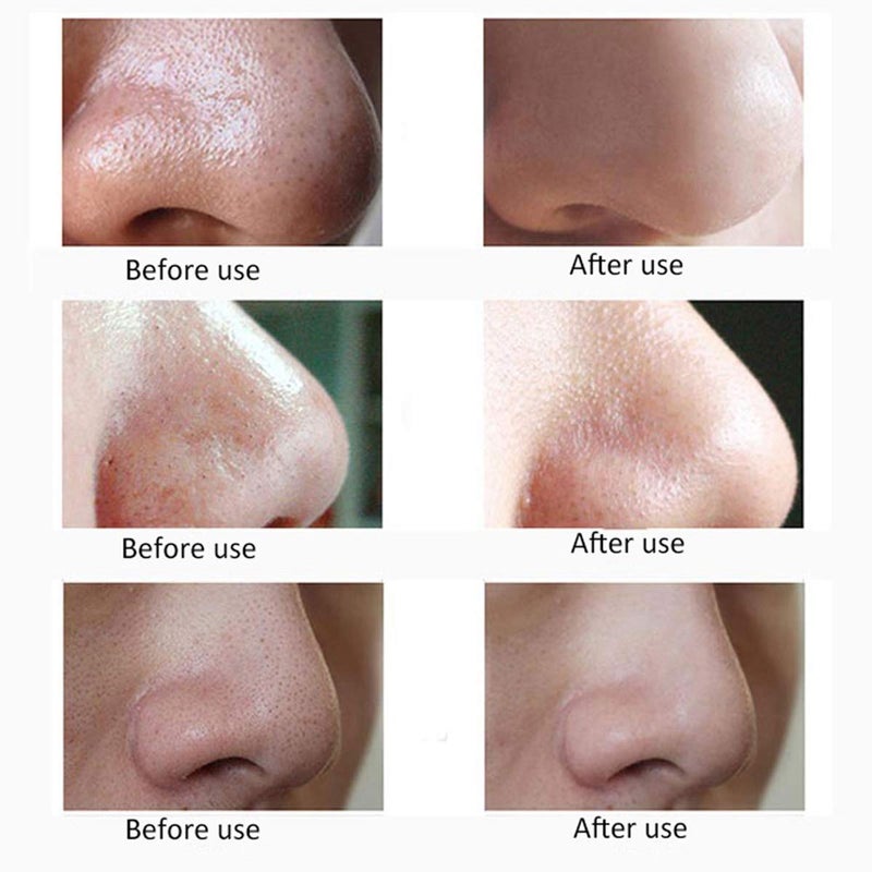 ATETO Blackhead Remover Pore Cleaner Pimple Extractor Skin Care Facial Vacuum Machine for Women and Men - Image 5