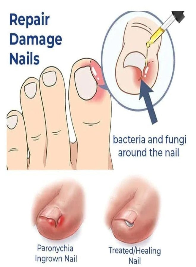 Perla Anti Paronychia Relief Oil 10ml | Natural Nail Infection Treatment Pain Relief & Disinfection for Swollen Skin, Ingrown Nails & Nail Inflammation | Anti-Fungal Nail Care Oil 10ml (1) - Image 3