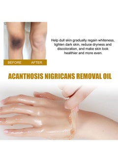 West&Month Peeling Plus-Acanthosis NigricansRremoval Oil,Dark Spot Corrector Oil, Acanthosis Nigricans Treatment For Dark Knuckle Finger Elbow And Knee Removal 50ML  - Image 4