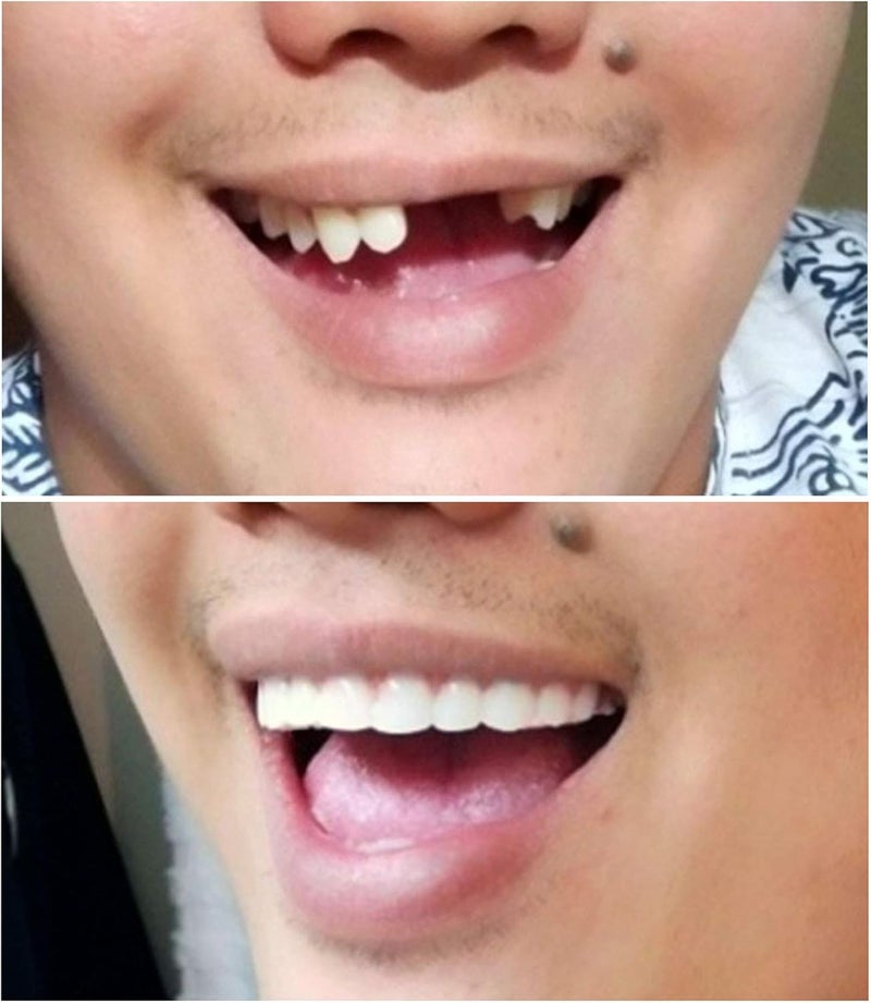 Instant Smile Comfort Fit Flex Cosmetic Upper Teeth Bright White Shade Comfortable Upper Veneer for Extended Wear Teeth Veneers for Men and Women 1 Size Fits Most - Image 5