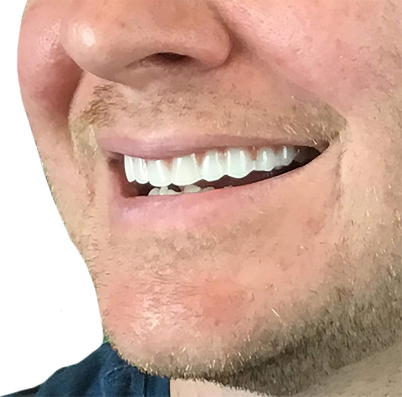 Instant Smile Comfort Fit Flex Cosmetic Upper Teeth Bright White Shade Comfortable Upper Veneer for Extended Wear Teeth Veneers for Men and Women 1 Size Fits Most - Image 3