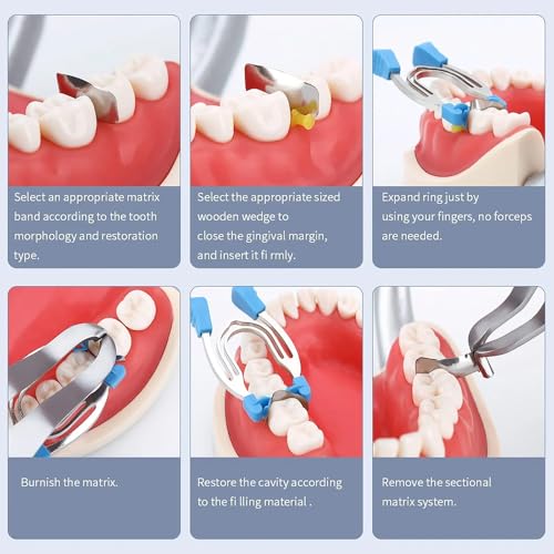 SeeFDENT Dental Matrix System Sectional Contoured Matrices Clip Clamp Forming Sheet Band Metal Spring Ring Autoclave - Image 4
