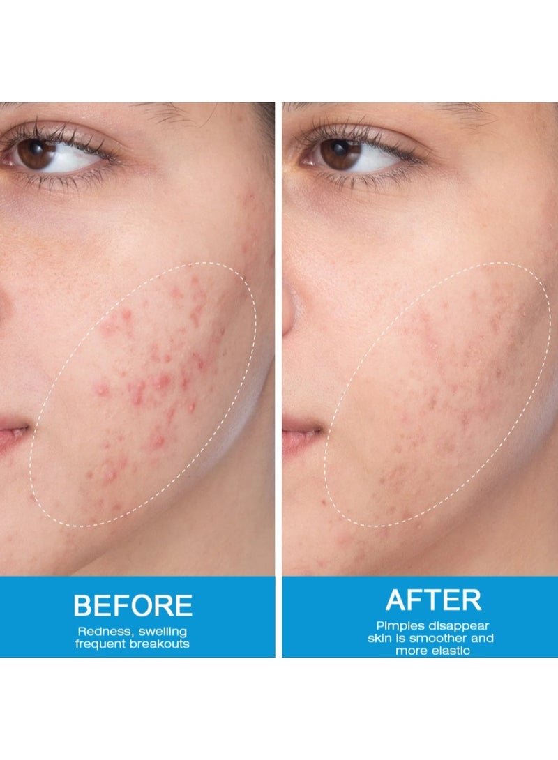 Sumifun Expigment 4% Cream 20g - Treatment for Melasma, Dark Spots & Uneven Skin Tone - Image 5