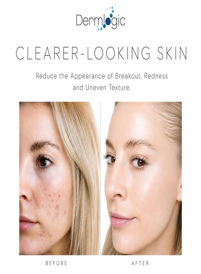 Dermlogic Acne Spot Treatment – Invisible Natural Formula Fights Cystic Acne, Pimples, Breakouts, Whiteheads, Zits & Clogged Pores. Fade Away Dark Spots, Acne Scars, Without Over Drying the Skin. All Skin Types - Image 5