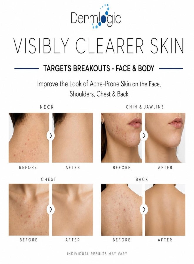 Dermlogic Acne Spot Treatment – Invisible Natural Formula Fights Cystic Acne, Pimples, Breakouts, Whiteheads, Zits & Clogged Pores. Fade Away Dark Spots, Acne Scars, Without Over Drying the Skin. All Skin Types - Image 3