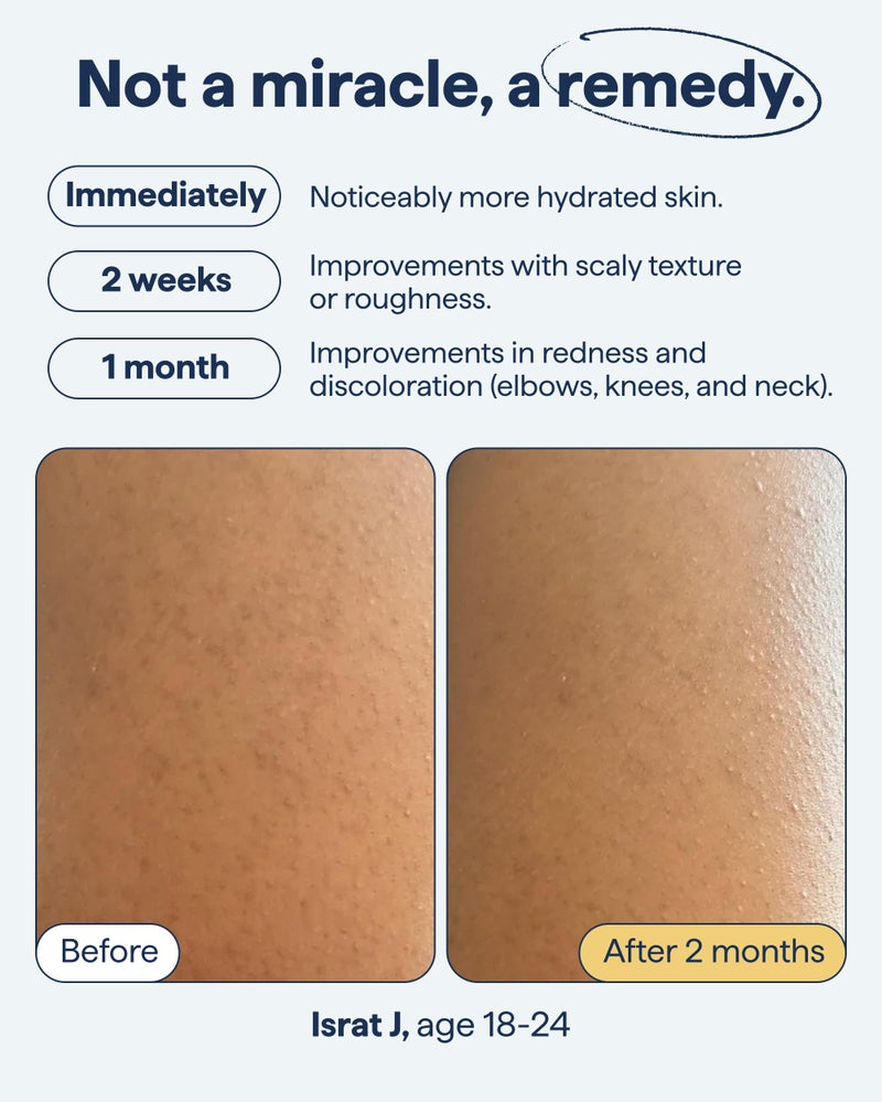 Remedy علاج لنتوءات الجسم - علاج لالتهاب الجريبات الشعرية (KP) والجلد الخشن والمجعد مع اليوريا وحمض اللاكتيك والريتينول - مرطب جسم مهدئ - بواسطة طبيب الجلدية الدكتور شاه - Image 5