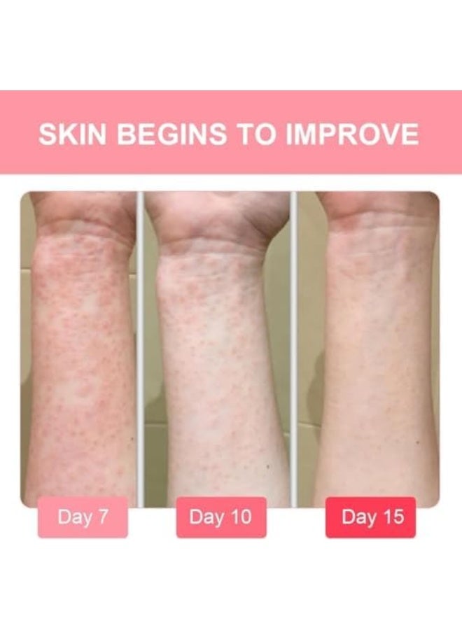 سوميفون كريم تخفيف الإكزيما، 100 جرام كريم للعناية بالبشرة لعلاج الإكزيما، يخفف الحكة والجفاف والقشور، يهدئ البشرة المتهيجة، مثالي لالتهاب الجلد في اليدين والقدمين، يرطب ويعزز حاجز البشرة. - Image 4