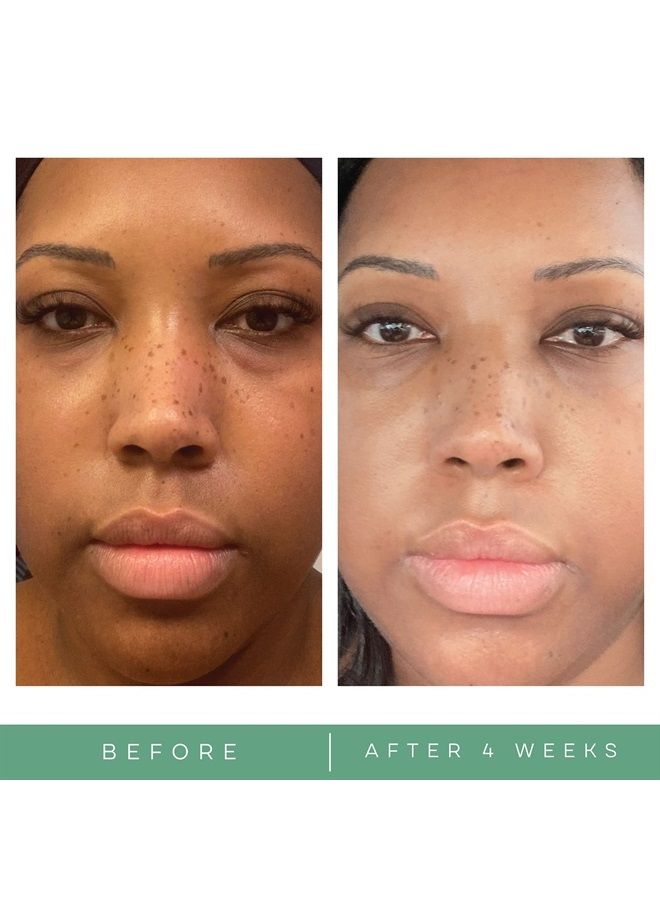 Replenix Brightening Eye Cream - Medical Grade Dark Circle Under Eye Treatment, Ultra Hyrdating, Brightening, Reduced Undereye Puffiness, 0.5 oz. - Image 4