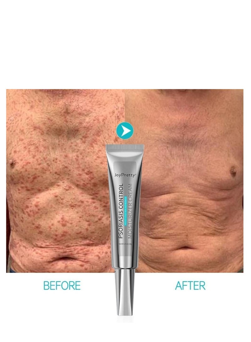 JoyPretty Psoriasis Relief Cream (20g), Anti-Bacterial Moisturizer for Scaly Skin & Redness – Natural Herbal Cream for Eczema, Dermatitis, Psoriasis, and Vitiligo – Unisex Skincare Solution - Image 5