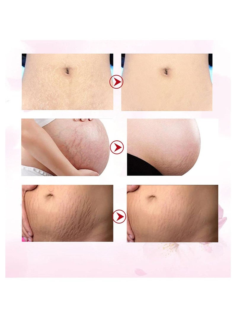 SYOSI 2 قطع كريم إزالة علامات التمدد، علامات الحمل السيئة للنساء وندبات حب الشباب، ترطيب وتثبيت بشرة الجسم، كريم علامات التمدد والندبات، كريم إزالة علامات التمدد والندبات للحمل - Image 2