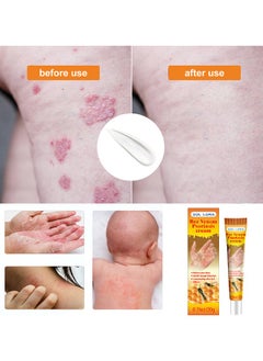 SOL LORA Bee Venom Psoriasis Cream, New Zealand Bee Venom Professional Psoriasis Cream For Itchy Skin Fast Relief Cream For Face And Body, Soothing And Moisturizing Psoriasis Cream 20G  - Image 5