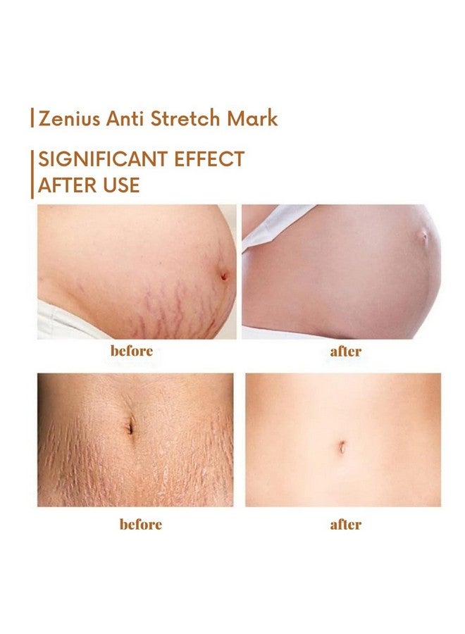 Zenius Stretch Mark Removal Cream For Women, Stretch Mark Cream For Pregnancy, Stretch Mark Cream During Pregnancy, Stretch Mark Removal Ceam After Pregnancy - 50g - Image 4