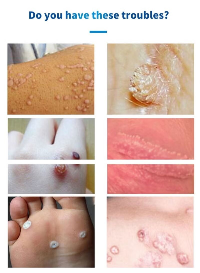 هيلموسز مزيل ثؤلول آمن وفعال بتركيبة عشبية طبيعية عالية الامتصاص وسريع المفعول يمنع إعادة نمو الثؤلول ومزيل الثؤلول لجميع أنواع البشرة نوع 10 مل - Image 3