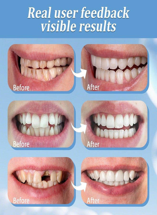 2 Pairs Unisex Temporary Smile - Natural, Adjustable & Comfortable Solution (1) - Image 5