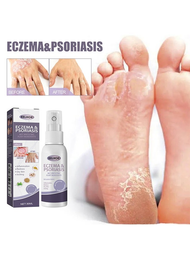 EELHOE Eczema & Psoriasis - Eczema & Psoriasis Atomizing Spray, Hand and Foot Moss Skin Repair, Relieve Itching, Skin care and Jiejia spray, Antibacterialnot Irritating Safety 30ML - Image 1