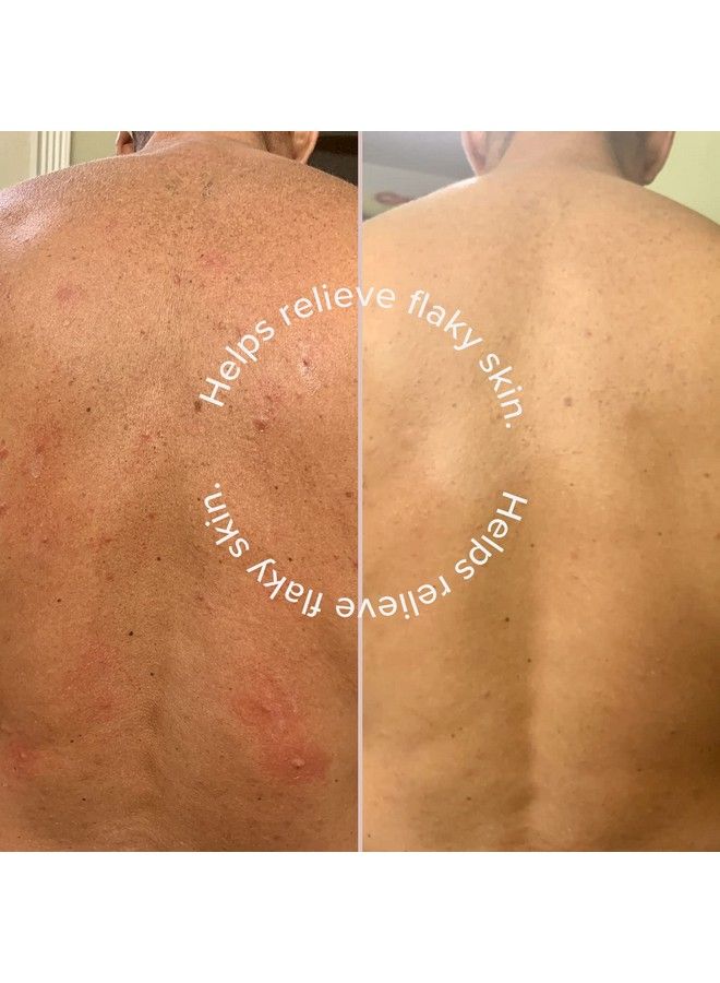 DRMTLGY Keratosis Pilaris Treatment Lactic Acid Skin Lotion. For Rough And Bumpy Skin Kp Dry Skin And Folliculitis. 12% Alpha Hydroxy Acid (Aha) Lotion - Image 3