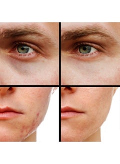 Concealer (Shade 5 of 6) Dark Circle Under Eye Cream Corrector, Multi-Use, Pimples, Scars, Rashes