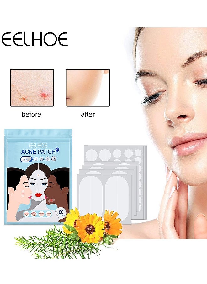 EELHOE Acne Pimple Patches, 5 Sizes 80 Patches For Large Zit Breakouts, Acne Patches For Face, Chin Or Body, Acne Spot Treatment With Tea Tree And Calendula Oil, Hydrocolloid Bandages For Acne Skin  - Image 1