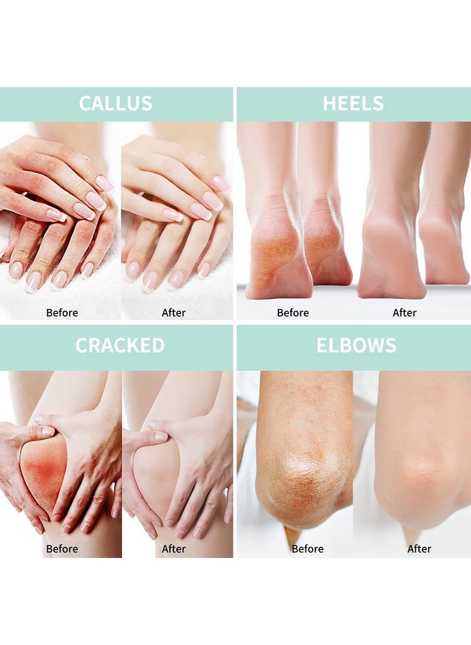 Grocerism - Urea Cream 40 Percent For Feet Plus 2% Salicylic Acid 5.29 Oz Foot Cream And Hand Cream Maximum Strength With Hyaluronic Acidtea Treeand Aloe Vera For Deep Moisturizescallus Remover - Image 1