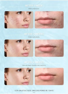 AuQuest Salicylic Acid Acne Face Cream Whitening Facial Treatment Hyaluronic Acid Black Dots Remove Skin Care Beauty Health Repairing Skin Base Essence 15ml  - Image 4