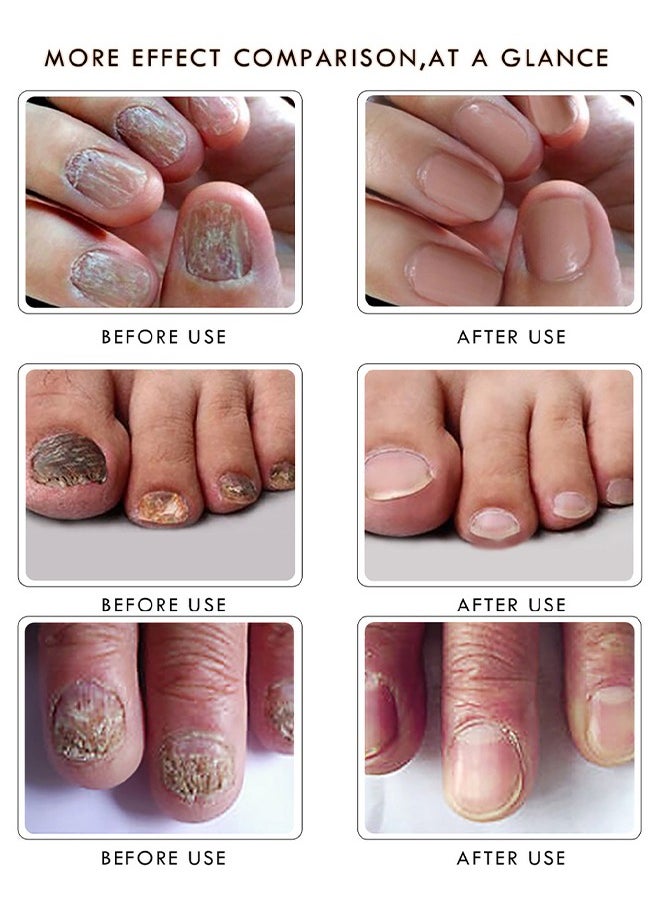 RtopR - Ginger Nail Essence - Has Antifungal And Antibacterial Properties, Relieves Nail Infections, And Promotes Nail Healing, Nail Treatment Healthy Nails Repair Essence 10ml - Image 1