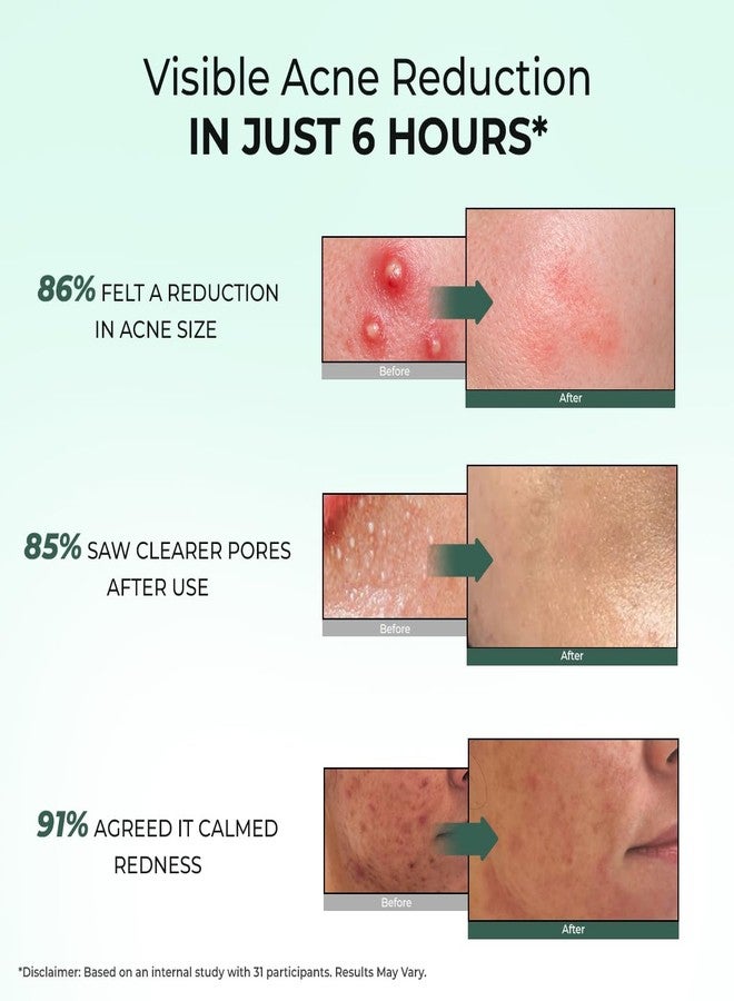 Conscious Chemist® Rapid Relief Acne Spot Corrector Gel 15g | 2% Salicylic Acid & Azelaic Acid Acne Spot Treatment | Pimple Removal Gel for Active Acne, Redness & Dark Spots | Fast-Acting Spot Corrector for Men & Women | Pack of 2 - Image 3