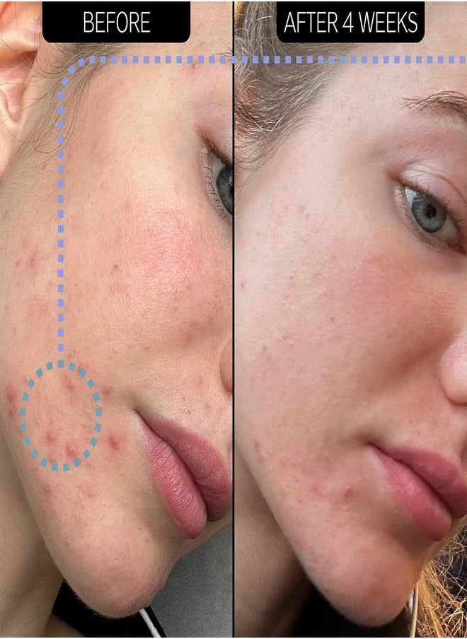 The Inkey List - The Inkey List Blemish Clearing Moisturizer - 2% NovoRetin 50ml - Image 1